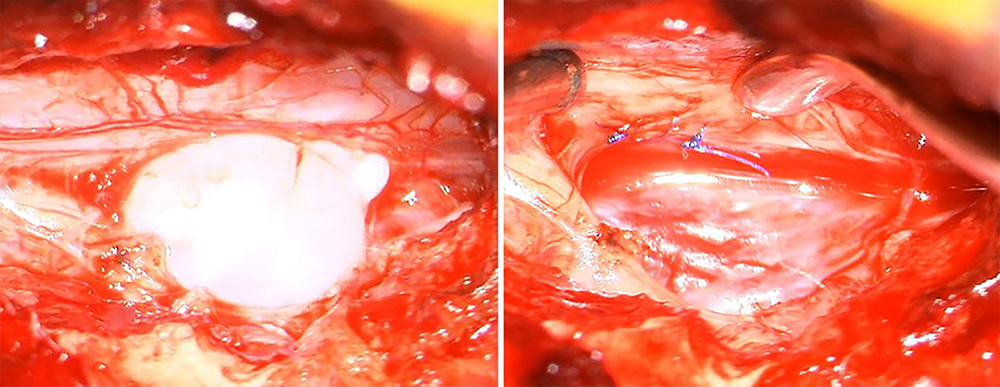 These photos of Maddie’s surgery show the out-pouching of the CSF-filled sac through the tear in the dura (left) and the operative results after the sac was removed and the tear in the dura sutured (right).