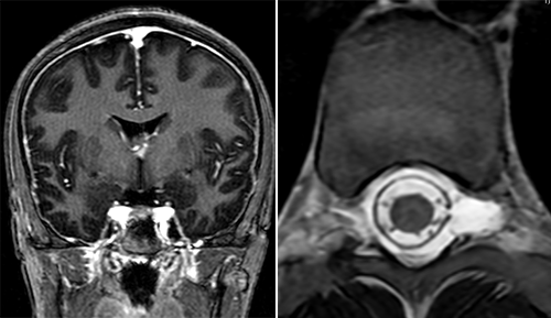 Diagnosing and treating a CSF leak requires a multi-step, multi-disciplinary approach. In Maddie’s case, the MRI scans held the first clues. Left: Evidence of intracranial hypotension in the brain. Right: An abnormal collection of fluid in the spine.