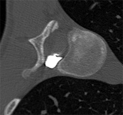 A dynamic CT myelogram identified the exact site of the CSF leak by revealing where the contrast agent had leaked.