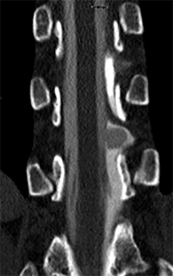 The dynamic CT myelogram also showed the CSF-filled sac protruding through the dural hole.