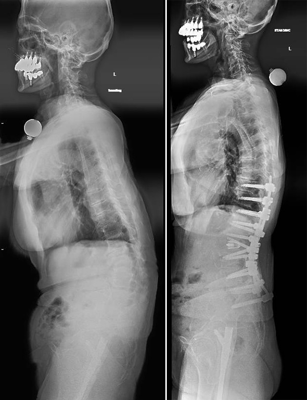 Scans of Pat Cusick's spine, before and after her corrective surgery for scoliosis