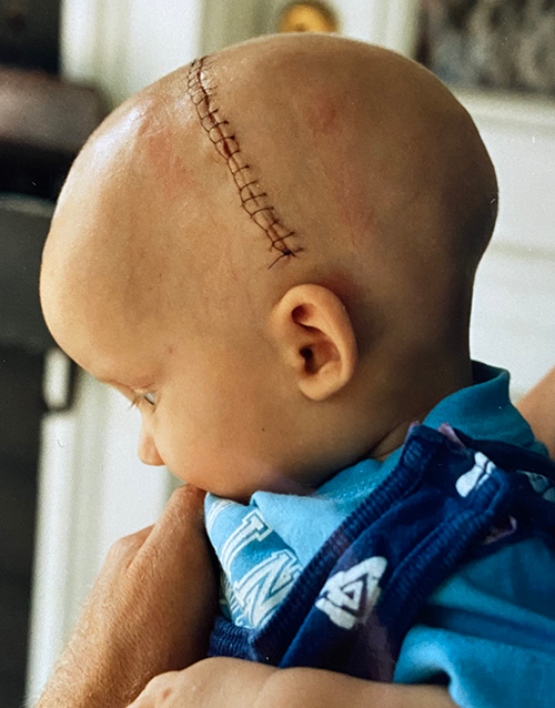 Will Clarkson as a baby, after craniosynostosis surgery
