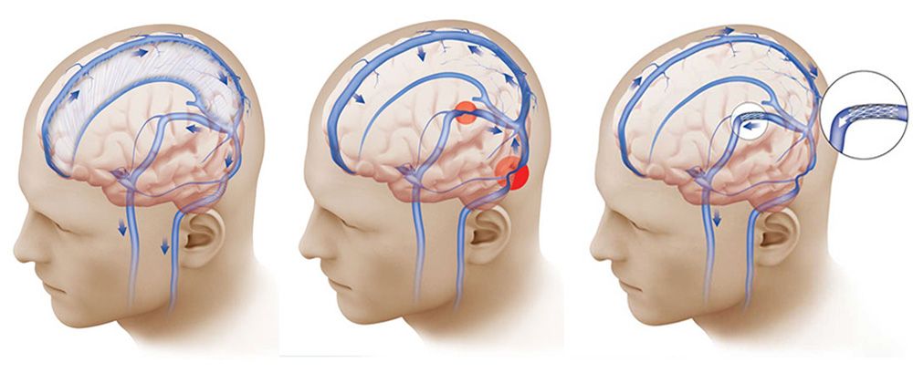 Venous Sinus Stenting for pulsatile tinnitus and IIH