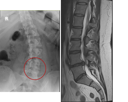Scoliosis images