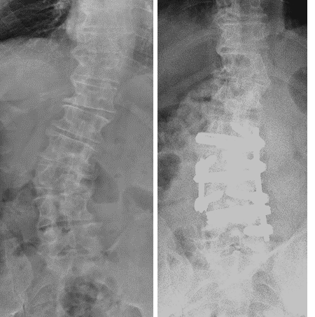 Scoliosis before and after surgery