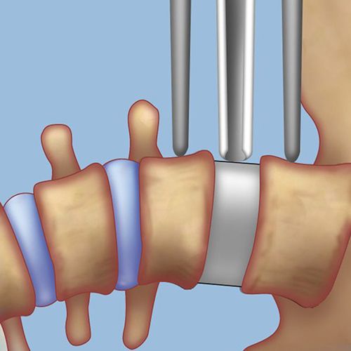 LLIF procedure for scoliosis