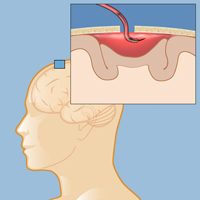 Endoscopic evacuation is a minimally invasive surgical technique to drain a subdural hemorrhage.