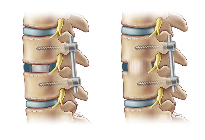 In a TLIF spinal fusion procedure (left), the neurosurgeon inserts a &quot;cage&quot; between the affected vertebrae to restore proper positioning. 